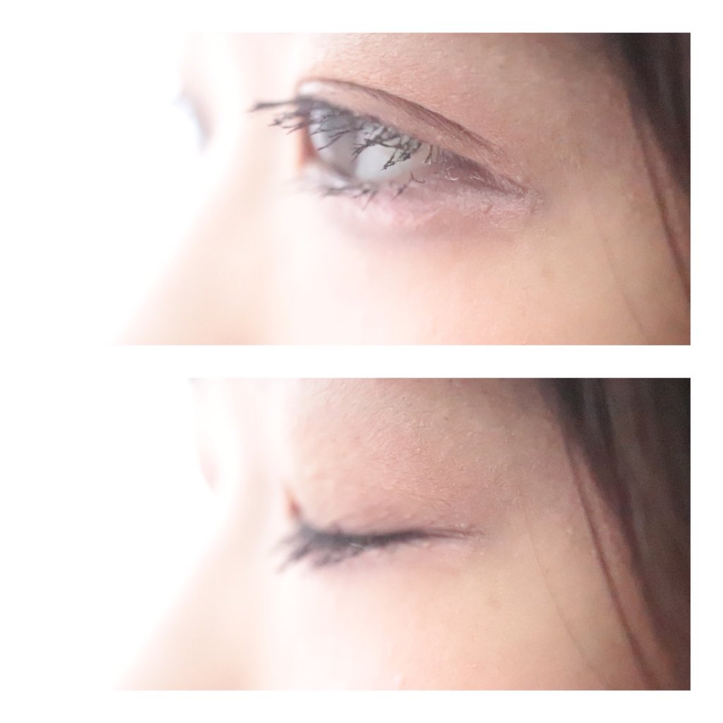 二重になりたい